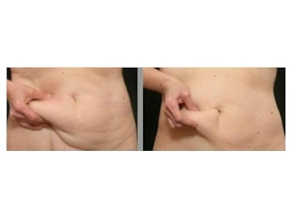 Konkurs "Sposoby pielęgnacji i modelowania ciała bez skalpela" do godz. 20:00