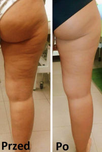 Wygraj zabieg redukcji cellulitu falą uderzeniową!