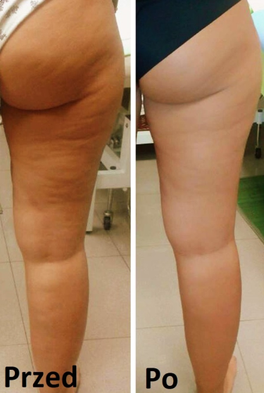Wygraj zabieg redukcji cellulitu falą uderzeniową!